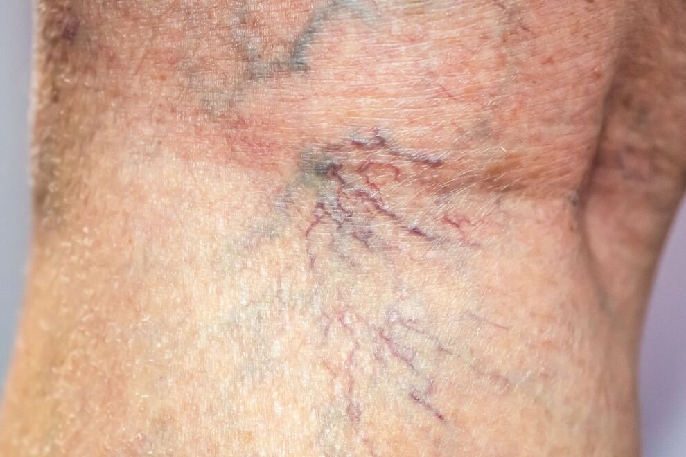 Varices on the body