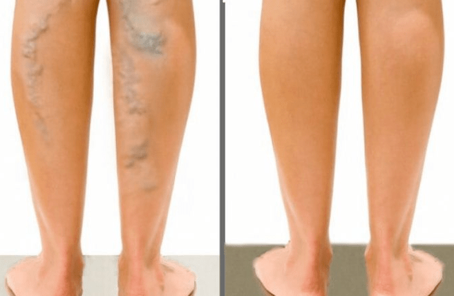 Varices before and after surgery