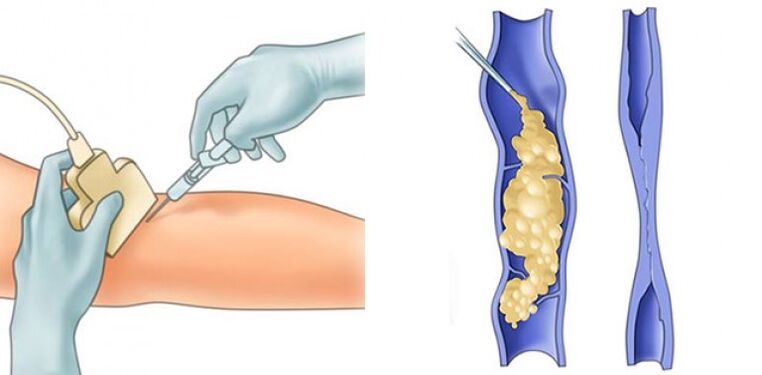 Varice treatment