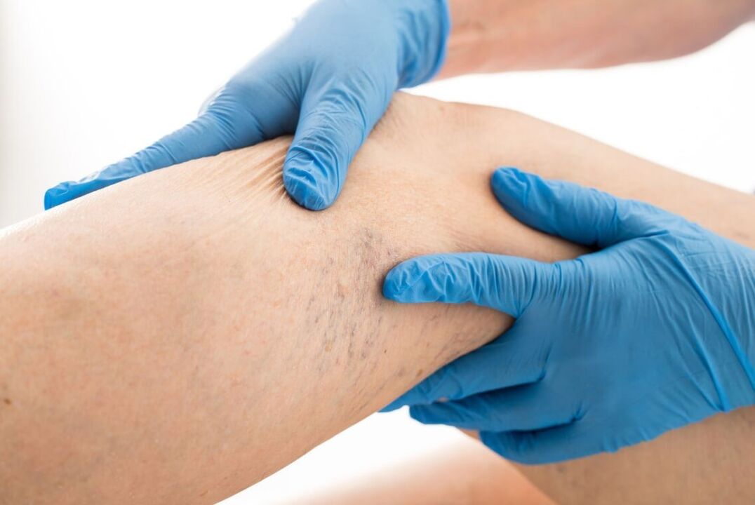 Varicuse Cartine Clinical Disease