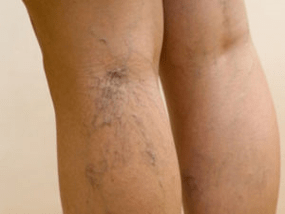 The second step of varicose veins
