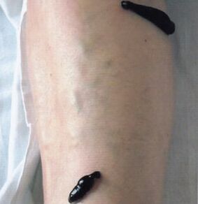 Hirudotherapy as a method of processing varicose veins