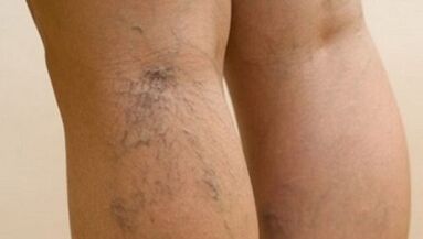 The causes of varicose veins