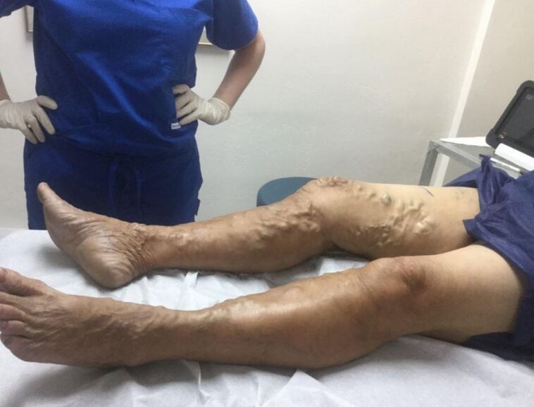 Consequences of not treating varicose veins