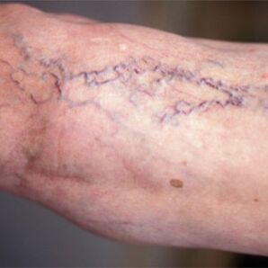 Varicose veins