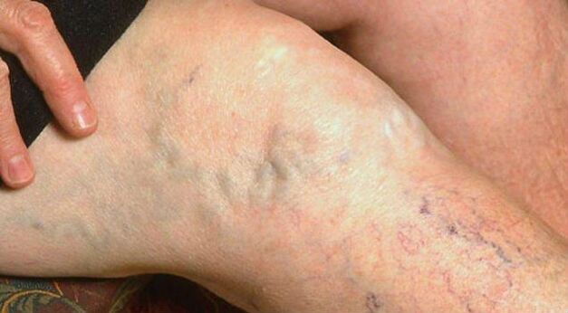 Visible symptoms of varicose veins on the legs