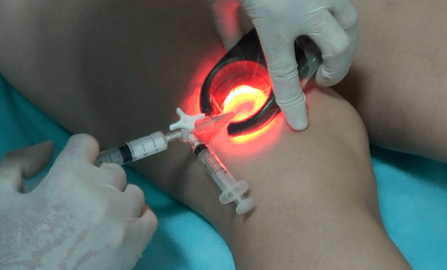 Sclerotherapy is an effective method for treating leg varicose veins