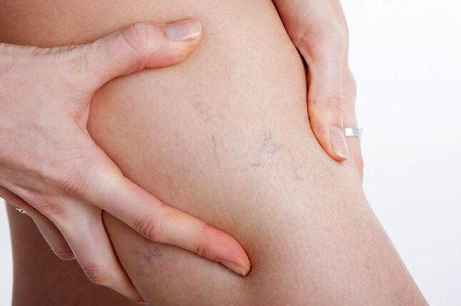 The first appearances of varicose veins on the leg