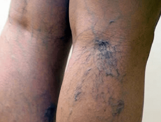 varicose veins on the legs